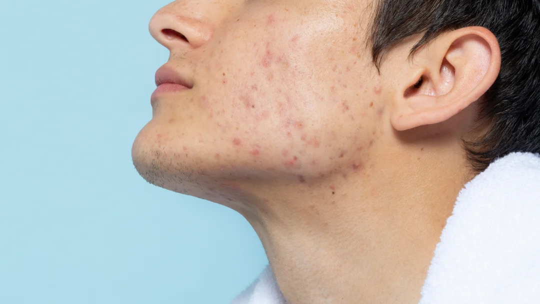 Un homme présentant des cicatrices d'acné sur le visage, illustrant les effets de l'acné sur la peau.