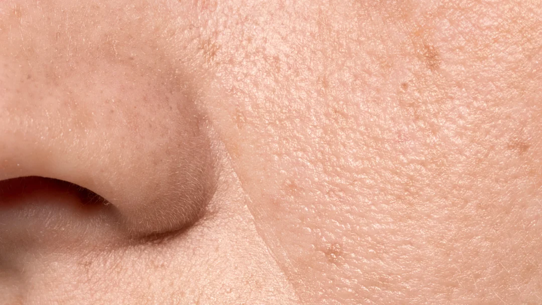 Gros plan sur le nez d'une femme, mettant en évidence des pores dilatés.